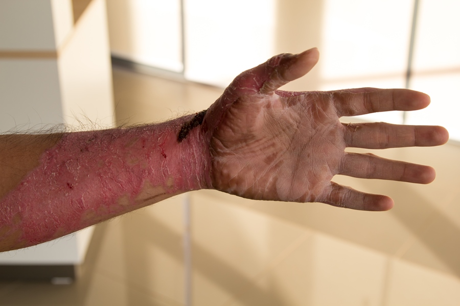 Psoriasis Flares from Alcohol Use: A Hidden Inflammatory Link